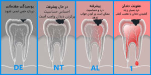 مراحل پوسیدگی دندان