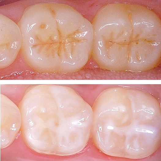 شیارپوش دندان
